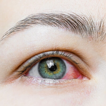 síndrome del ojo seco | Marta Montoya